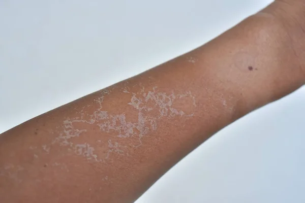 Arm droge huid peeling na de zon verbrand — Stockfoto