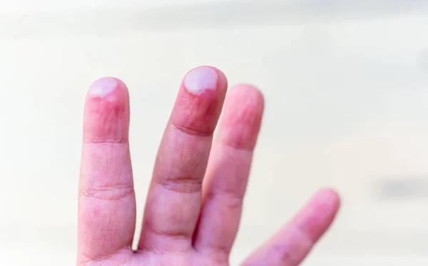 Κυψέλη Στα Παιδιά Δάχτυλο Που Προκαλείται Από Τραυματισμό Στο Ζεστό — Φωτογραφία Αρχείου