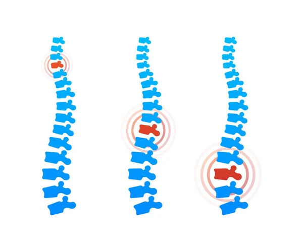 Vector human spine with pain isolated silhouette illustration. Spine pain medical center, clinic, rehabilitation. Vector illustration. — Stock Vector