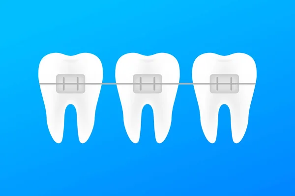 Correção dos dentes com aparelho ortodôntico. Estágios de alinhamento dos dentes. Serviços de clínica dentária. Ilustração vetorial . — Vetor de Stock