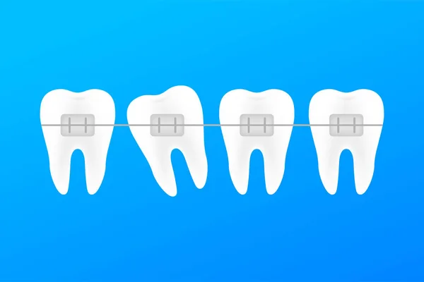 Correção dos dentes com aparelho ortodôntico. Estágios de alinhamento dos dentes. Serviços de clínica dentária. Ilustração do estoque vetorial . — Vetor de Stock