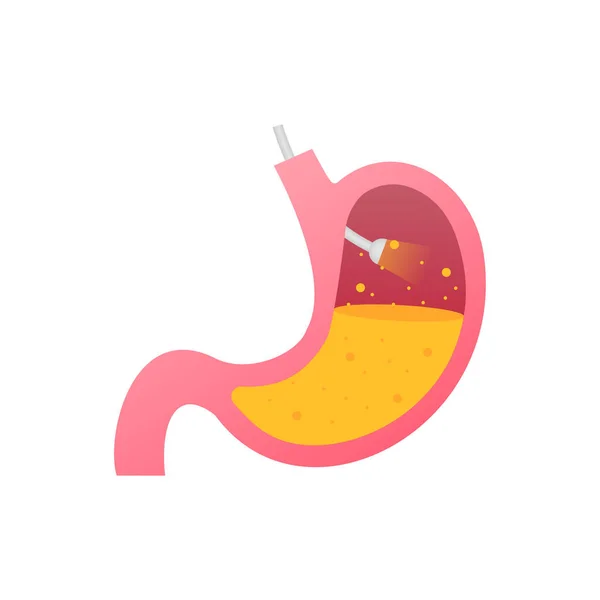 Endoscopia estomacal. Endoscopio en el estómago a través del esófago. Ilustración de stock vectorial. — Vector de stock