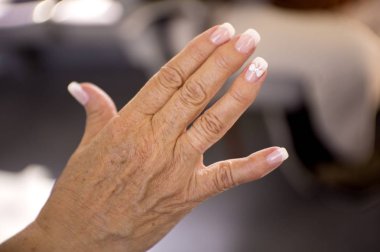 Romatizma, osteoartrit ve cilt lekeleri sorunları olan bir orta yaşlı kadının elleri