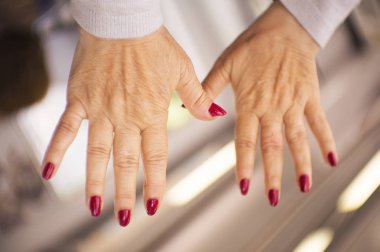 Romatizma, osteoartrit ve cilt lekeleri sorunları olan bir orta yaşlı kadının elleri