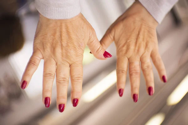 Hands Middle Aged Woman Problems Rheumatism Osteoarthritis Skin Blemishes — Stock Photo, Image