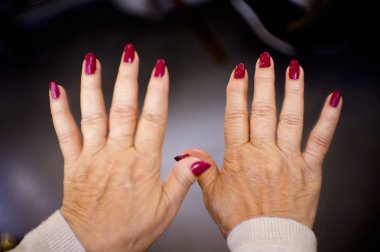 Romatizma, osteoartrit ve cilt lekeleri sorunları olan bir orta yaşlı kadının elleri