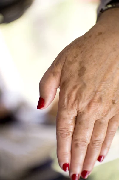 リウマチ 変形性関節症や皮膚の傷の問題と中年女性の手 — ストック写真