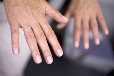 Romatizma, osteoartrit ve cilt lekeleri sorunları olan bir orta yaşlı kadının elleri