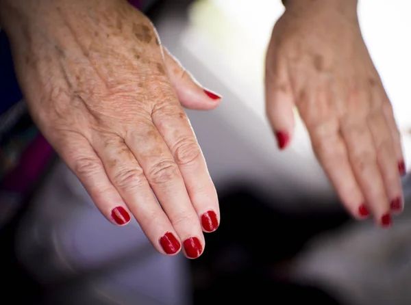 Hände Einer Frau Mittleren Alters Mit Problemen Bei Rheuma Arthrose — Stockfoto