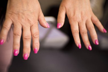 Romatizma, osteoartrit ve cilt lekeleri sorunları olan bir orta yaşlı kadının elleri