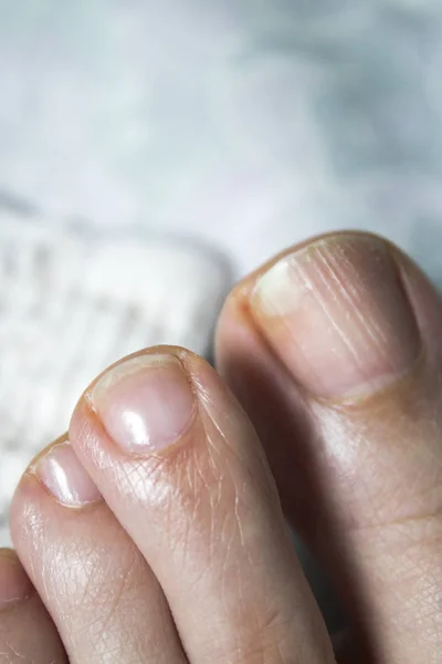 Toenail with fungus — Stock Photo, Image