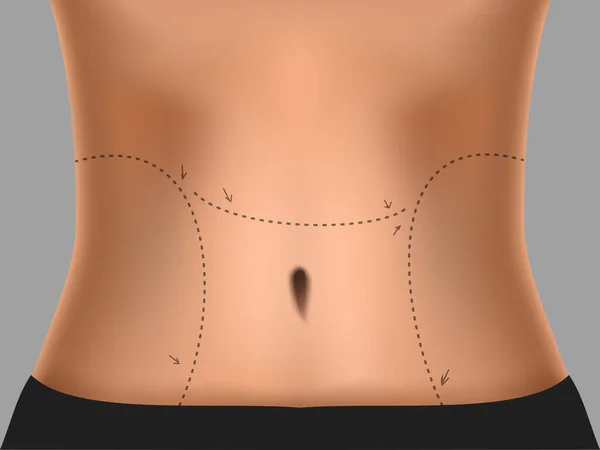 Línea Punteada Marcada Barriga Para Cirugía Plástica Vector Eps10 — Archivo Imágenes Vectoriales