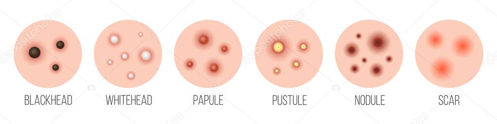 Creative vector illustration types of acne, pimples, skin pores, blackhead, whitehead, scar, comedone, stages diagram isolated on transparent background. Art design . Abstract concept graphic element