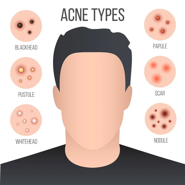 Creative vector illustration types of acne, pimples, skin pores, blackhead, whitehead, scar, comedone, stages diagram isolated on transparent background. Art design . Abstract concept graphic element — Stock Vector