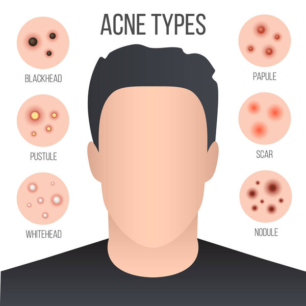 Creative vector illustration types of acne, pimples, skin pores, blackhead, whitehead, scar, comedone, stages diagram isolated on transparent background. Art design . Abstract concept graphic element