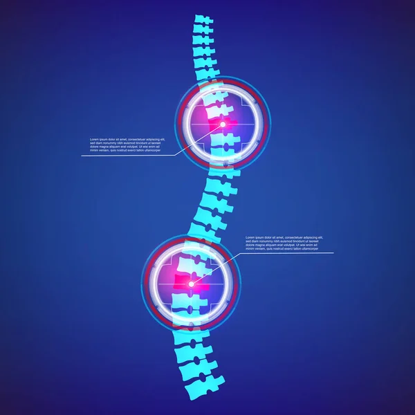 척추 x-선, 목 통증, 디스크 저하, 배경에 부상 치료의 크리에이 티브 벡터 일러스트. 아트 디자인 의료 배너 템플릿입니다. 추상 개념 의료 infographic 그래픽 요소 — 스톡 벡터