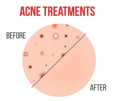 Creative vector illustration types of acne, pimples, skin pores, blackhead, whitehead, scar, comedone, stages diagram isolated on transparent background. Art design . Abstract concept graphic element clipart