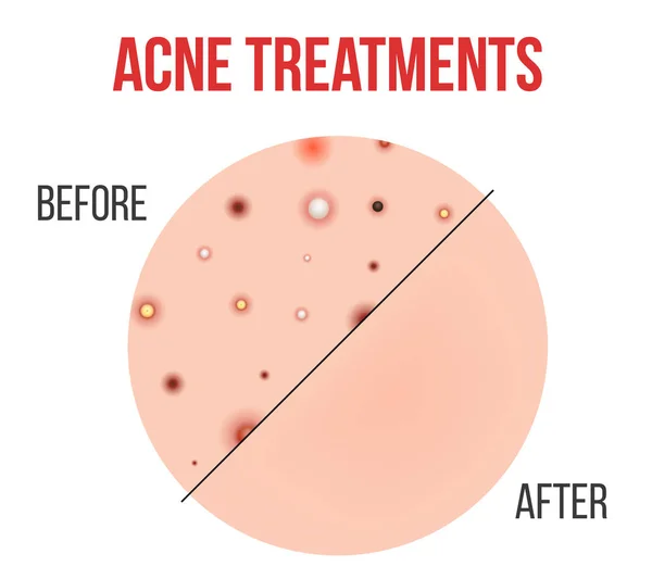 Tipos criativos de ilustração vetorial de acne, espinhas, poros da pele, cravo, whitehead, cicatriz, comedone, diagrama de estágios isolados em fundo transparente. Design de arte. Elemento gráfico do conceito abstrato —  Vetores de Stock