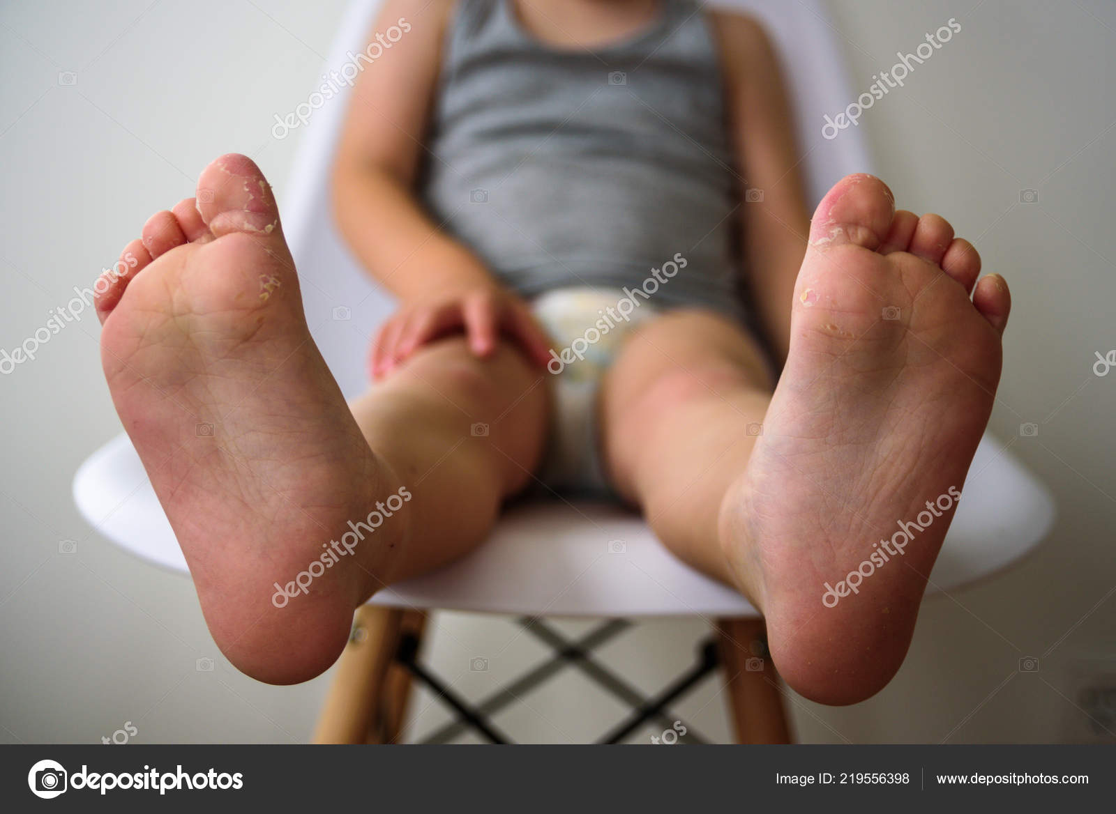 baby foot eczema