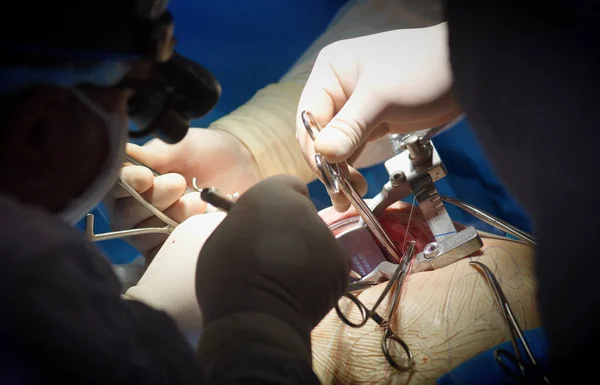 Medische Benodigdheden Instrumenten Liggen Tijdens Operatie Tafel Operatiekamer — Stockfoto