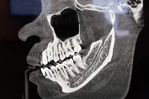 Digital x-ray of jaw from the side view