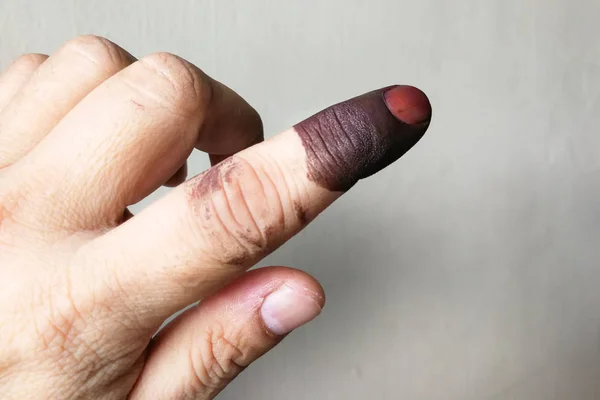 Index finger with indelible ink stain after voting in general election in Malaysia