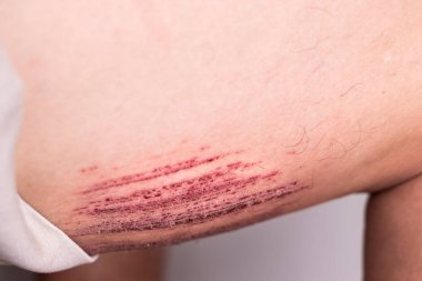 Aşındırıcı yanlışlıkla düşmek içine drenaj sonucu acı yaralı uyluk ile kişi