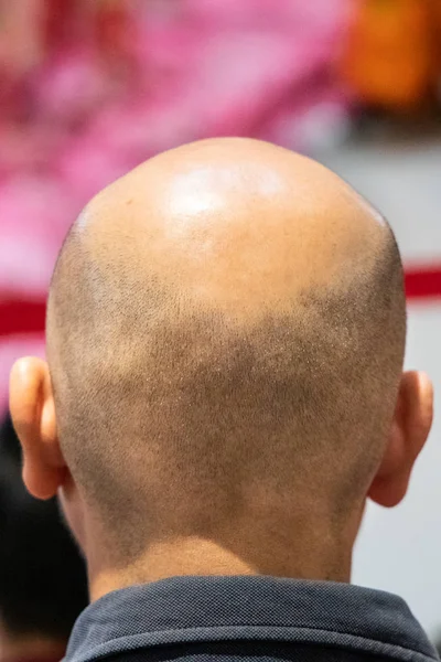 Close-up do homem com couro cabeludo raspado sofrem calvície calva — Fotografia de Stock