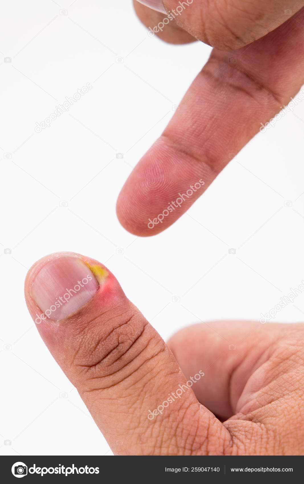 A Baby, Pus, a Nail Grew into a Finger Stock Image - Image of disgusting,  feet: 292678301