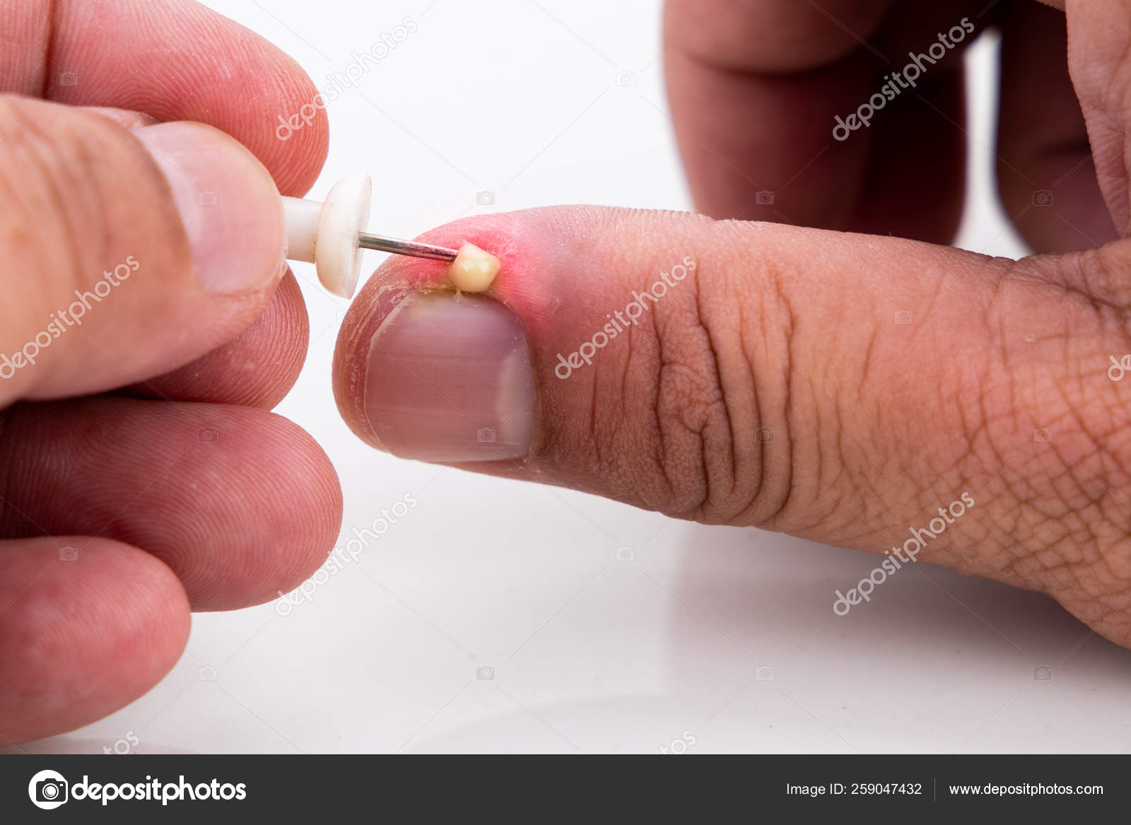 Series of painful finger nail skin infection with pus treatment Stock Photo by ©Thamkc 259047432 Series of painful finger nail skin infection with pus treatment Stock Photo by ©Thamkc 259047432