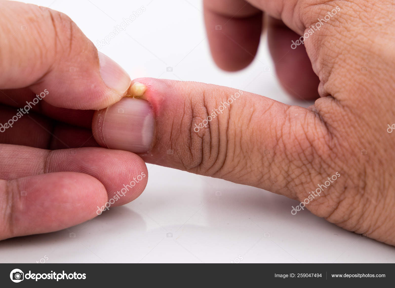Series Of Painful Finger Nail Skin Infection With Pus Treatment Stock Photo By C Thamkc
