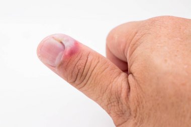 Series of painful finger nail skin infection with pus treatment clipart