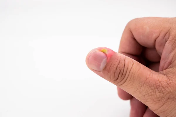 Serie de infección dolorosa de la piel de las uñas con tratamiento de pus — Foto de Stock