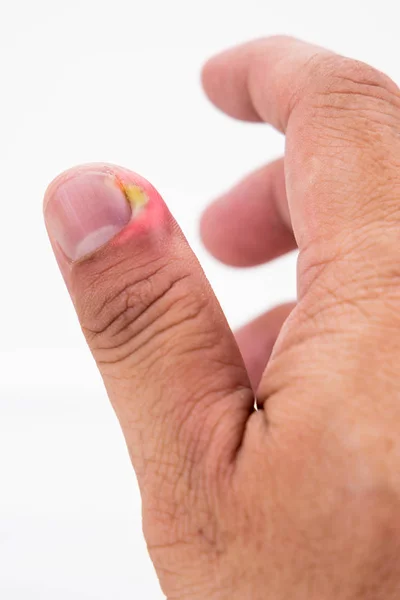 Serie schmerzhafter Fingernagelhautinfektionen mit Eiterbehandlung — Stockfoto