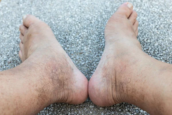 Huidpigmentatie op verwaarloosde poot van gerijpte mannelijke Aziatische — Stockfoto
