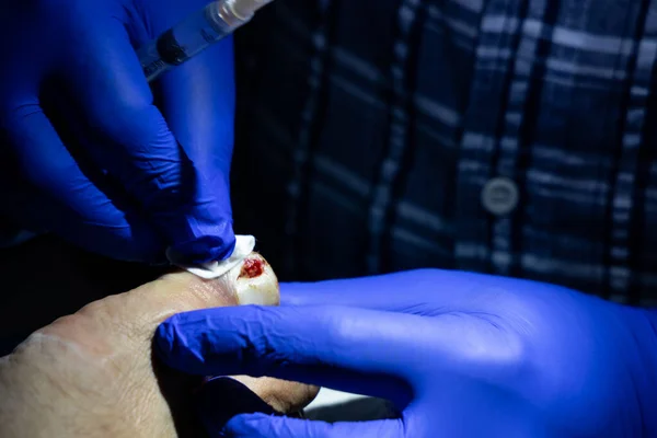 Serie Tratamiento Uñas Encarnadas Médico Limpieza Herida Antes Cirugía Uña — Foto de Stock