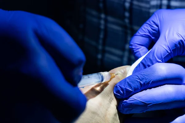 Serie Tratament Unghii Înrădăcinate Medicul Injectează Anestezic Local Deget Seringă — Fotografie, imagine de stoc
