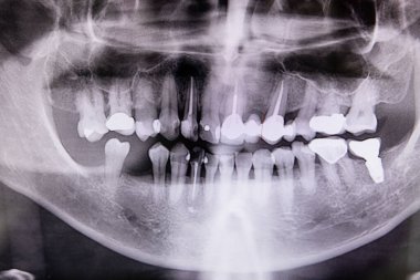 Diş kliniğinde kök kanalı, dolgu maddesi ve ortodontik implantı olan dijital diş röntgeni.