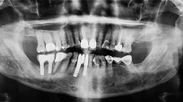 Diş kliniğinde kök kanalı, dolgu maddesi ve ortodontik implantı olan dijital diş röntgeni.