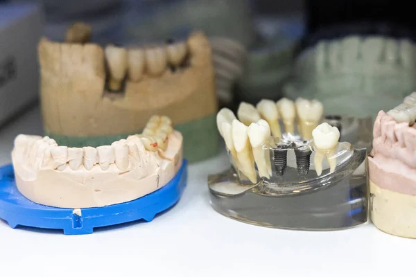 Various Dental Cast Models Focus Cast Model Teeth Implants Right — Stock Photo, Image