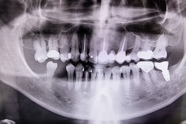 Radiografía Digital Del Perfil Dentario Con Conducto Radicular Empastes Implante — Foto de Stock