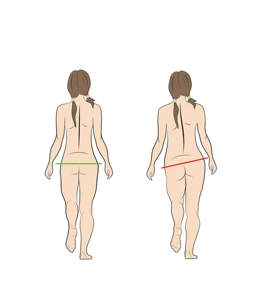 Нормальна Неправильна Хода Жінки Медичні Рекомендації Векторна Ілюстрація — стоковий вектор