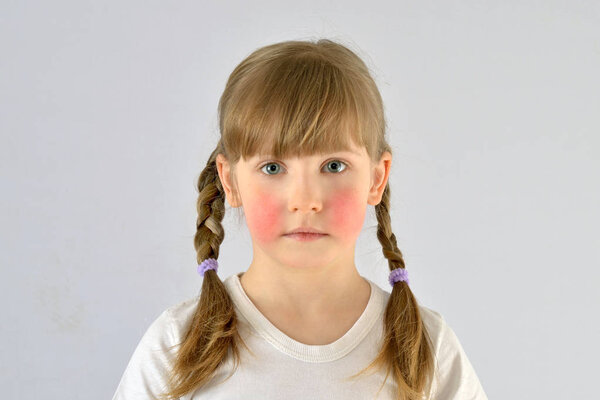 child, kid, has red cheeks skin irritation