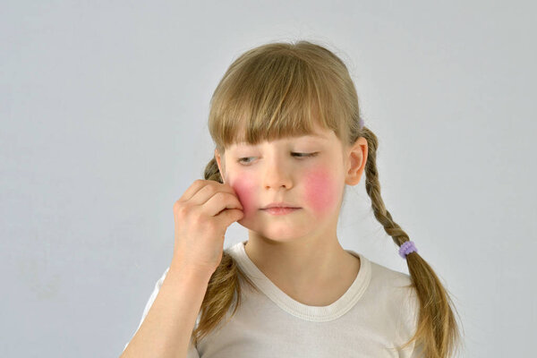 child, kid, has dry skin diathesis