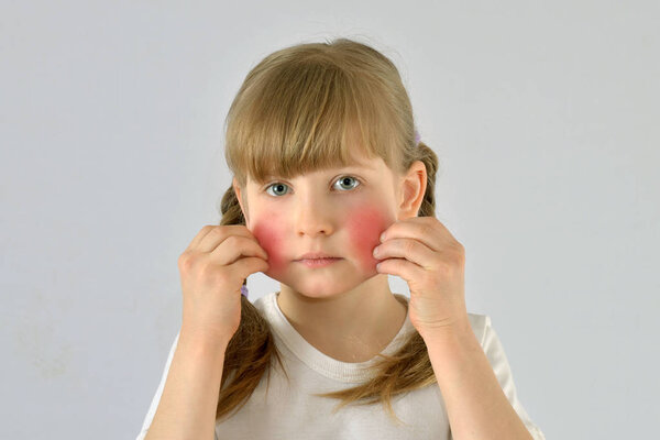 child, kid, has skin disease redness irritation