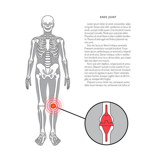 Prótesis de hombro, banner vectorial con lugar para texto. ilustración médica — Vector de stock