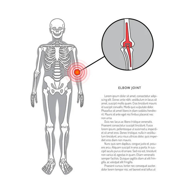 Schulterprothese, Vektorbanner mit Platz für Text. Medizinische Illustration — Stockvektor