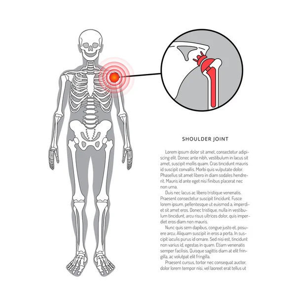 Prótesis de hombro, banner vectorial con lugar para texto. ilustración médica — Vector de stock