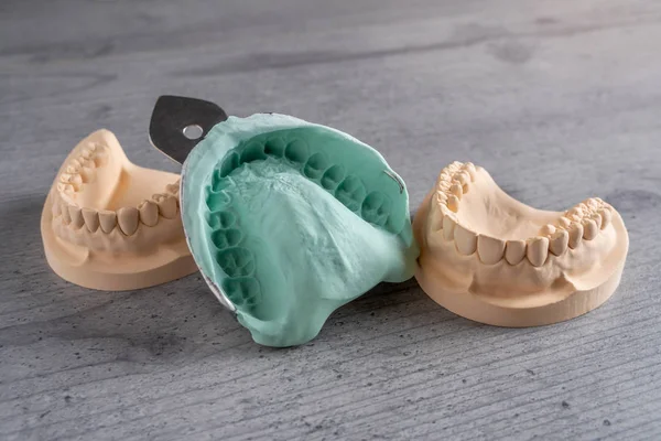上下顎と歯科技工所義歯や入れ歯の一連の製造のための柔軟なプリントのものが歯の石膏鋳造金型 — ストック写真
