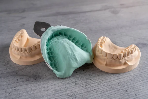 Moldes Yeso Mandíbulas Dientes Superiores Inferiores Con Una Impresión Flexible Imágenes De Stock Sin Royalties Gratis